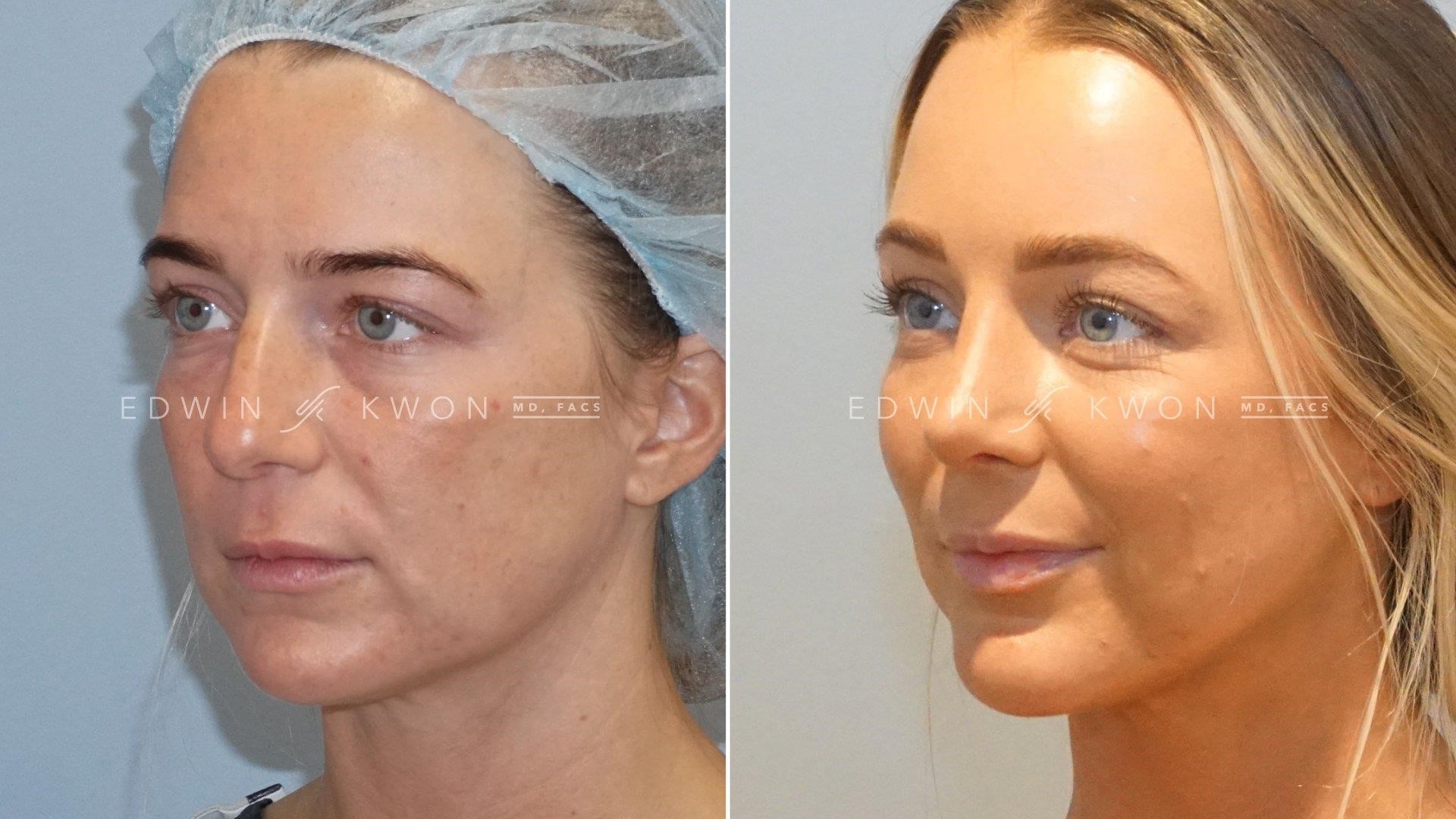 how much is rhinoplasty surgery